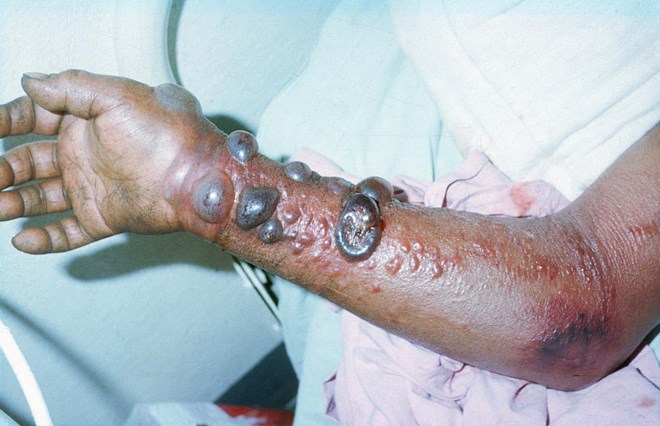 Biểu hiện của một bệnh nhân mắc bệnh Ebola, ảnh healthjade