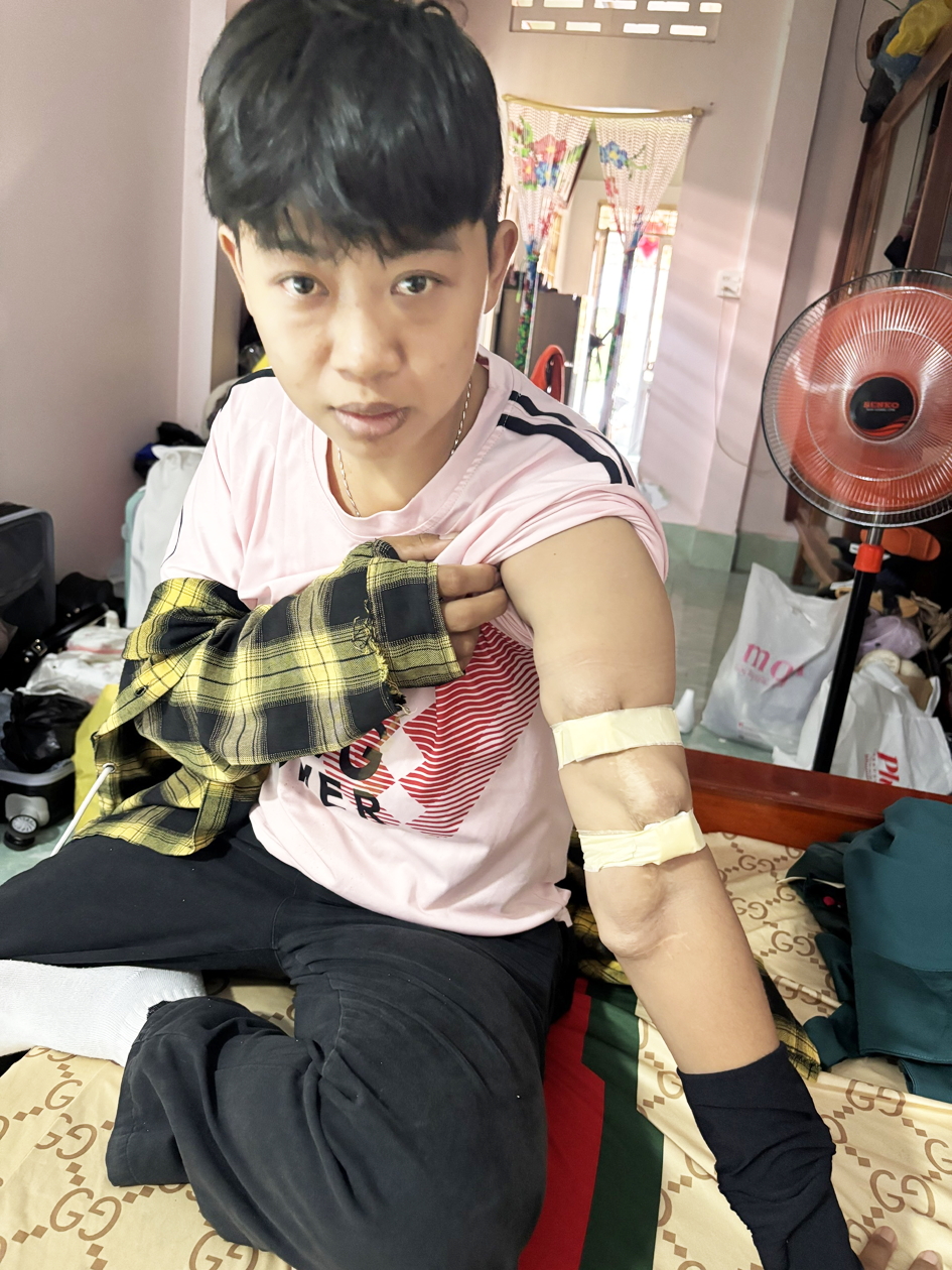 Cánh tay chị Cao Thị Kỳ Duyên bị phù nề,  di chứng của 6 năm chạy thận