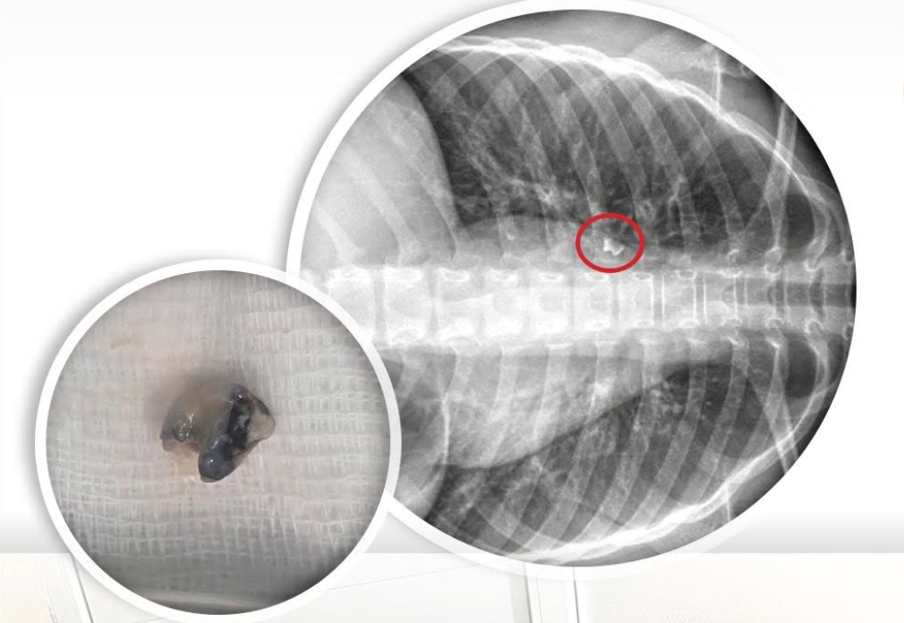 Chiếc răng mắc kẹt sâu trong phế quản bé trai 9 tuổi được gắp ra ngoài - Ảnh: H.Yến