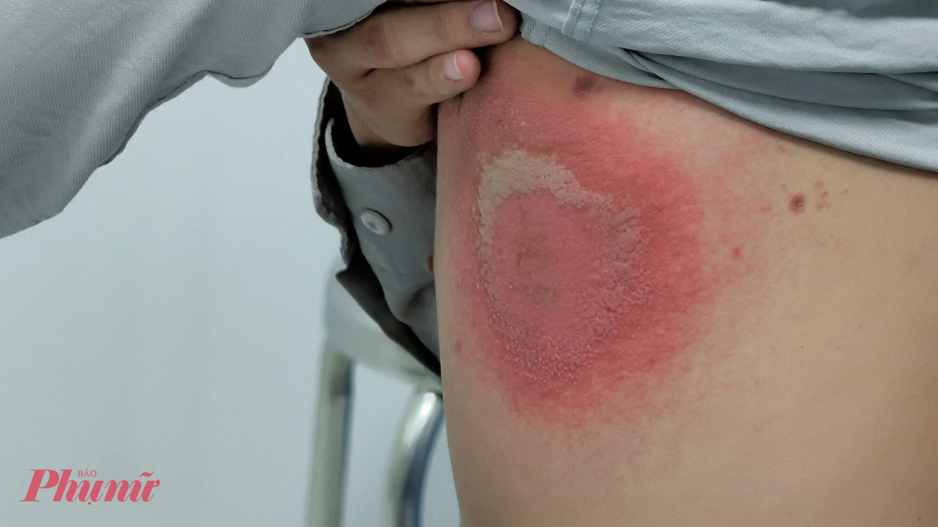 Bệnh nhân chủ quan nên bị viêm da nghiêm trọng