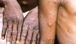 Phát hiện ca nhiễm đậu mùa khỉ đầu tiên, TPHCM khẩn trương ngăn chặn lây lan