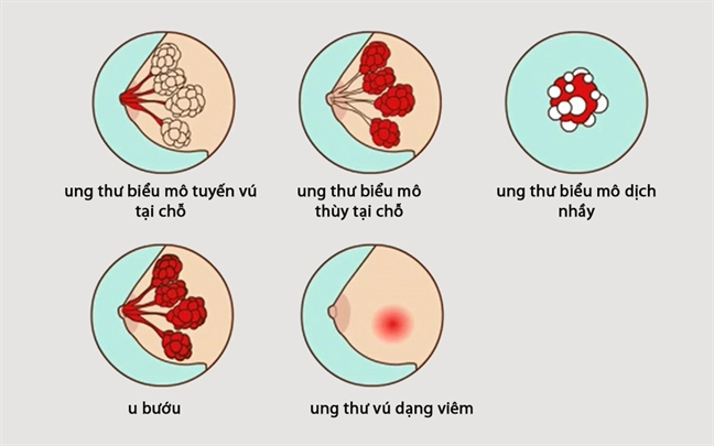 9 dau hieu nhan biet som ung thu vu o chi em