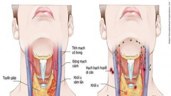 Thấy những biểu hiện này bạn cần đi khám ngay để phát hiện sớm ung thư vòm họng