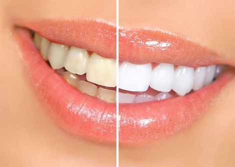 Nguy hại của việc tẩy trắng răng tại nhà bạn nên biết