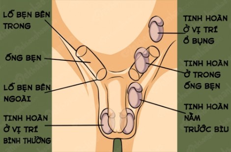 Tinh hoàn... đi lạc 20 năm khiến người đàn ông bị ung thư tinh hoàn nặng nề