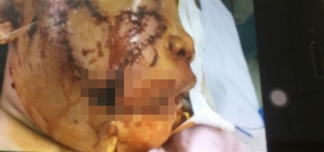 Thương tâm bé gái 5 tuổi bị chó cắn nát nửa khuôn mặt, lộ cả hai hàm răng