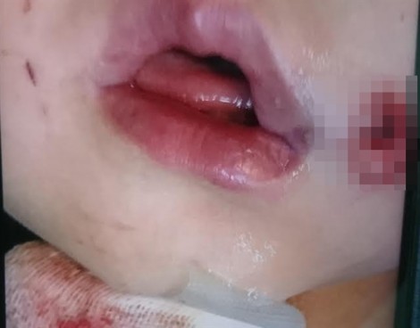 Bình gas mini phát nổ trong lúc ăn tiệc, bé gái 2 tuổi thủng mặt