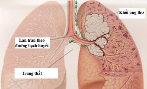 Thường xuyên đốt than đá, củi, gỗ cũng bị ung thư phổi