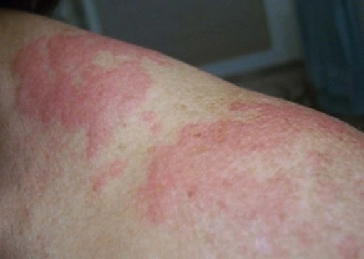 Nắng nóng, nhiều người nổi ban