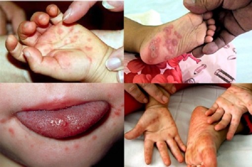 Kinh nghiệm phòng bệnh tay chân miệng tại nhà