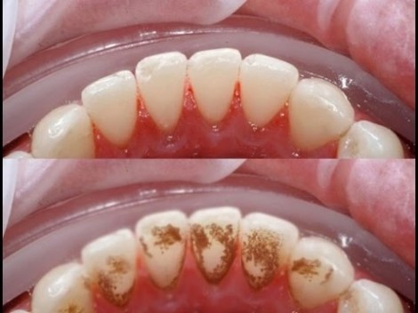 Chưa đến 1 phút bạn có thể làm sạch hết mảng bám cao răng