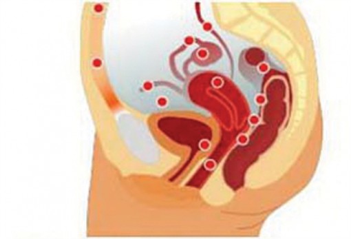 Mổ lạc nội mạc tử cung làm tăng  nguy cơ vô sinh
