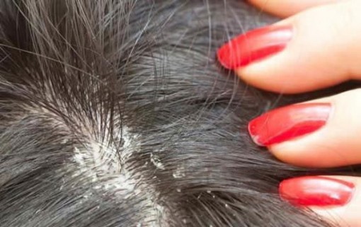 5 nguyên nhân ngứa da đầu nhưng nhiều người không nghĩ ra