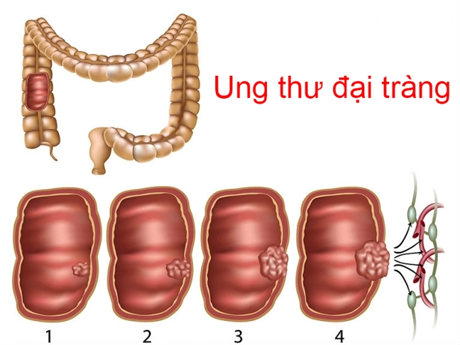 Moi nam Viet Nam co gan 9.000 nguoi bi ung thu dai truc trang