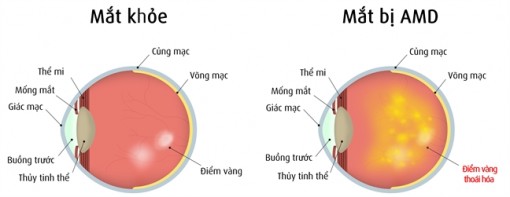 Thuốc nhỏ mắt 'thần kỳ' cứu hàng nghìn người khỏi mù lòa