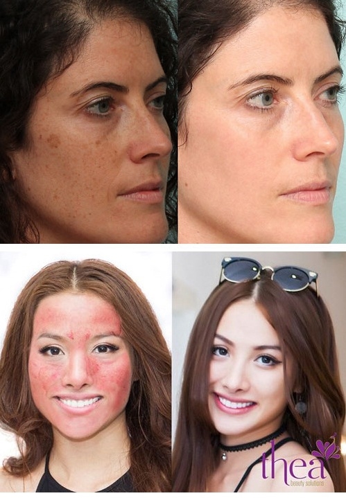 Da dep khong can son phan voi Laser ket hop PRP