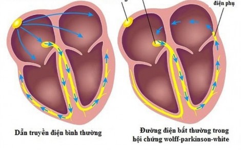 Cụ bà suýt chết vì hồi hộp khó thở, đánh trống ngực liên tục