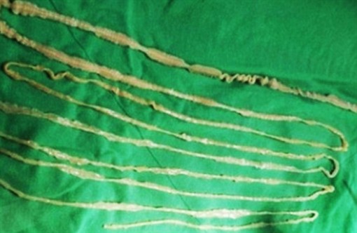 Sán dây dài hơn 2m bò trong bụng vì ăn món sashimi