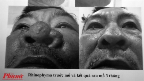 Bác sĩ công bố loạt ảnh hiếm về đàn ông Việt mắc bệnh mũi sư tử