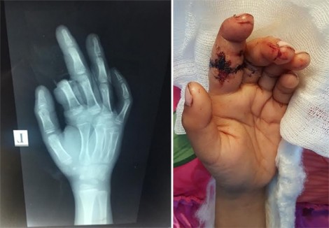 Bé trai 8 tuổi bị bạn chặt đứt ngón tay