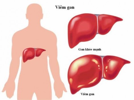 Men gan tăng cao có nguy hiểm?