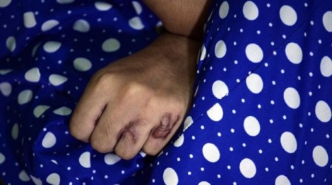Ấn Độ: Cô gái bị tạt axit đến lần thứ năm vì thù hằn dai dẳng