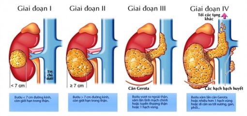 Mỗi năm Việt Nam có hơn 600 người chết vì ung thư thận