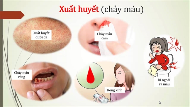 Sot xuat huyet gia tang: 'Vach mat' diem nguy co de xu phat