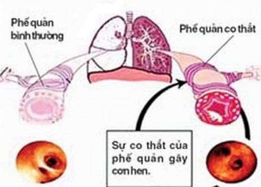Kỳ lạ bệnh nhân ho một lần phun ra gần 1 lít máu