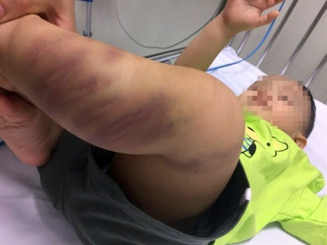 Bé trai 1 tuổi nguy kịch vì nghi bị bạo hành, không có người thân chăm sóc