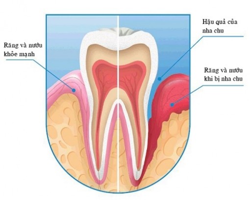 Phụ nữ mắc bệnh này dễ bị ung thư
