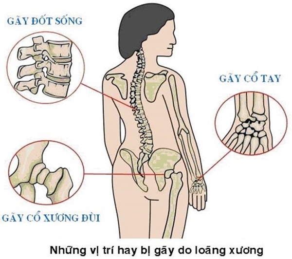 Tuoi 'be gay sung trau' cung… liet giuong vi loang xuong