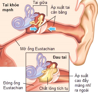 Liet mat, meo mieng vi bien chung viem tai giua