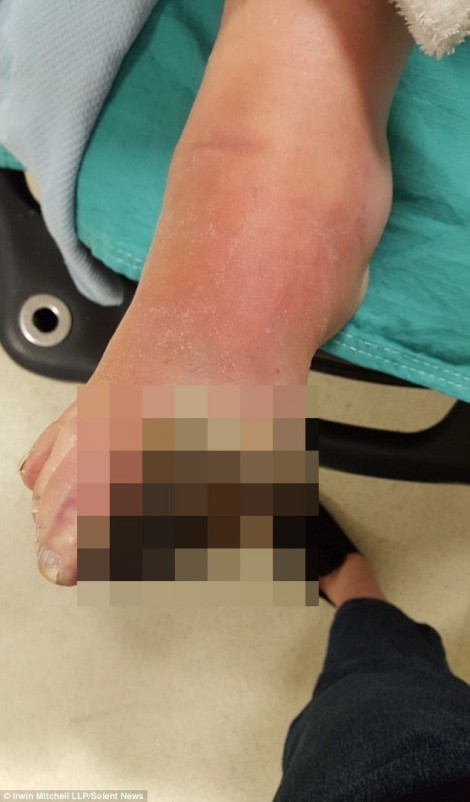 Bệnh nhân khởi kiện bệnh viện vì bị cắt cụt chân