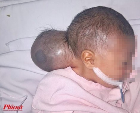Sinh ra 'hai đầu', bé 2 ngày tuổi bị gia đình bỏ rơi
