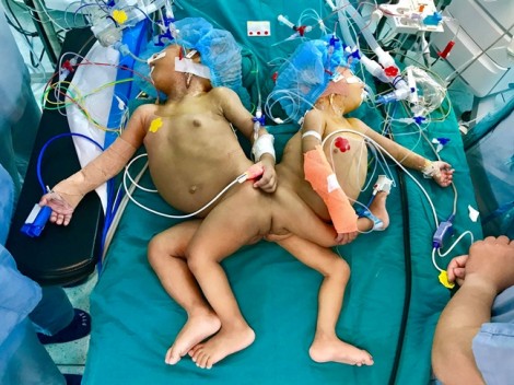Hơn 20 bác sĩ Sài Gòn mổ tách 2 bé song sinh dính liền mông