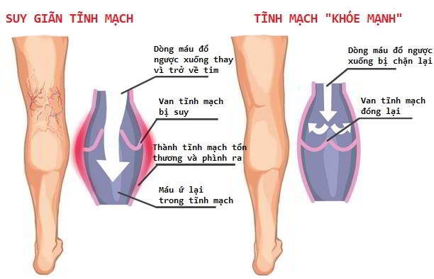 Dieu tri suy gian tinh mach bang keo sinh hoc