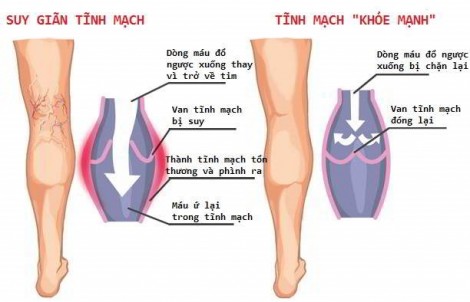 Điều trị suy giãn tĩnh mạch bằng keo sinh học