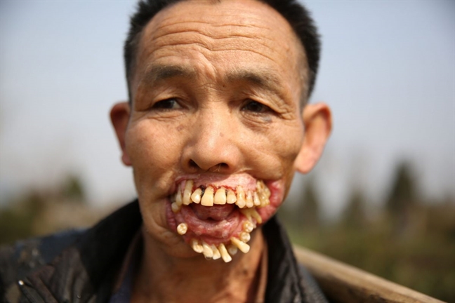 Những hàm răng kinh dị nhất thế giới - Báo Phụ Nữ