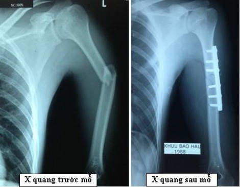 Quên nẹp vít trong xương… 9 năm