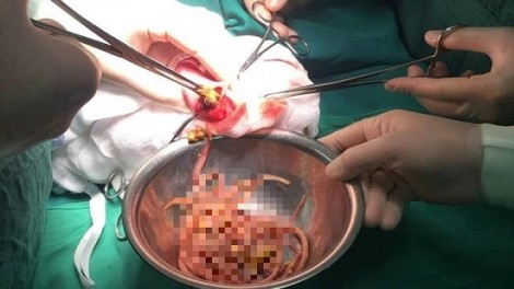 Phẫu thuật lấy túi giun khủng trong ruột bé gái 3 tuổi