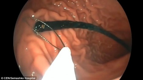 Bác sĩ bỏ quên ống dẫn thức ăn trong dạ dày bệnh nhân suốt 17 năm