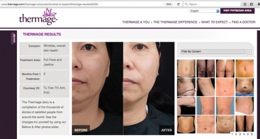 'Lai lịch' tấm ảnh trên trang web của hãng Thermage (Mỹ)?