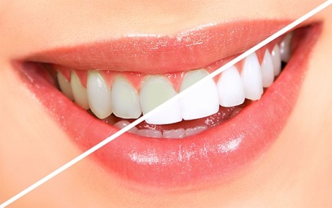 Cách làm trắng răng tại nhà từ thực phẩm thiên nhiên hiệu quả