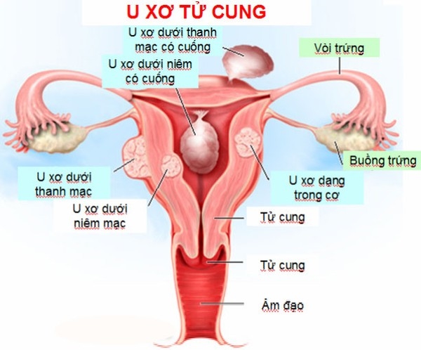 Bac si ‘bat ngua’ vi nguoi phu nu bi u xo tu cung to bang bung bau 5 thang