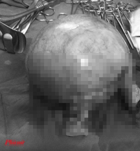Bác sĩ ‘bật ngửa’ vì người phụ nữ bị u xơ tử cung to bằng bụng bầu 5 tháng