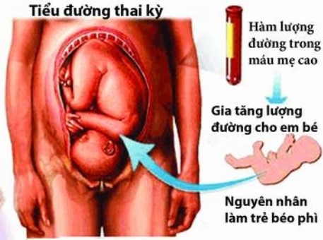 Thai nhi tu vong vi me an qua nhieu do ngot