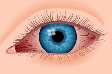7 nguyên nhân khiến bạn bị đỏ mắt và cách xử lý
