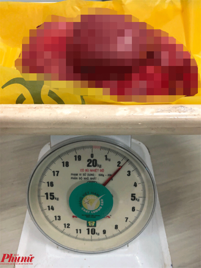 Rong kinh suot mot nam, nguoi phu nu khong ngo mang khoi u gan 2,5 kg