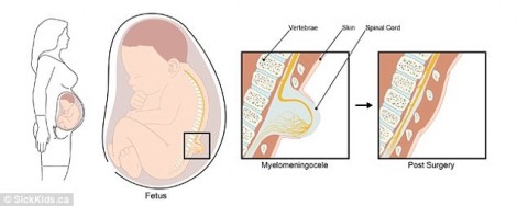 Phẫu thuật nứt xương cột sống cho thai nhi trong bụng mẹ